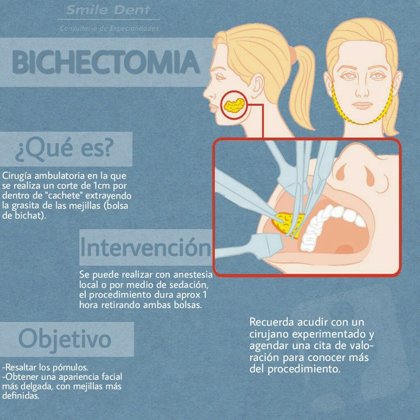 Bichectomia