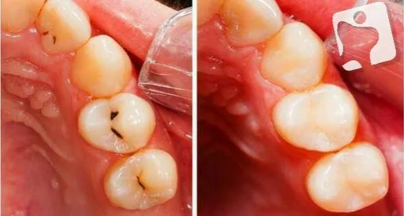 Resinas dentales