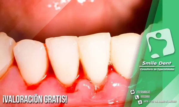 Limpieza dental